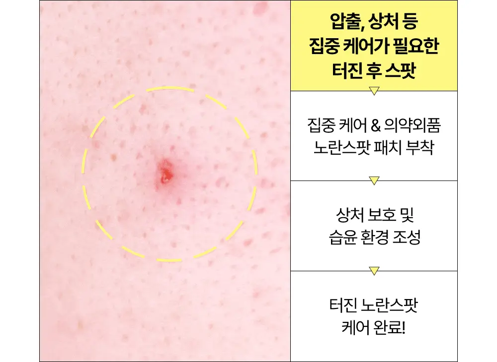 [올영단독기획 / 짜기 전/후 구성] 해서린 스팟케어 패치 키트 대용량 기획 140매 상세페이지 27